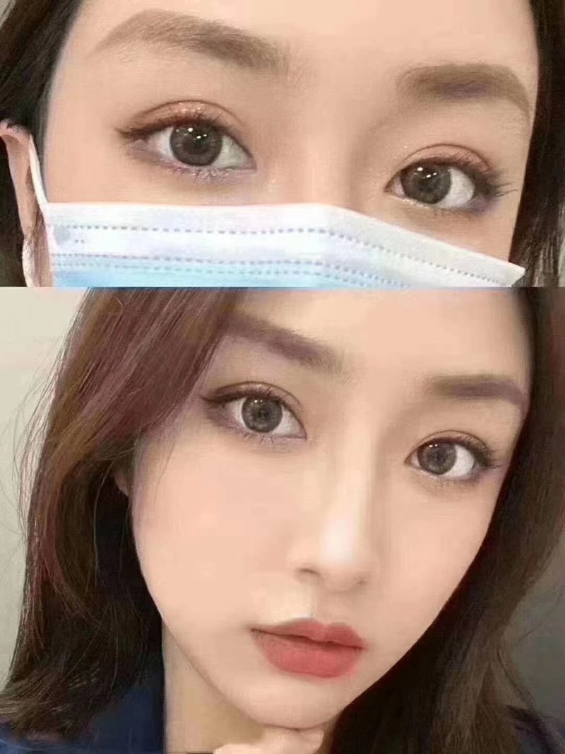 郑州双眼皮手术